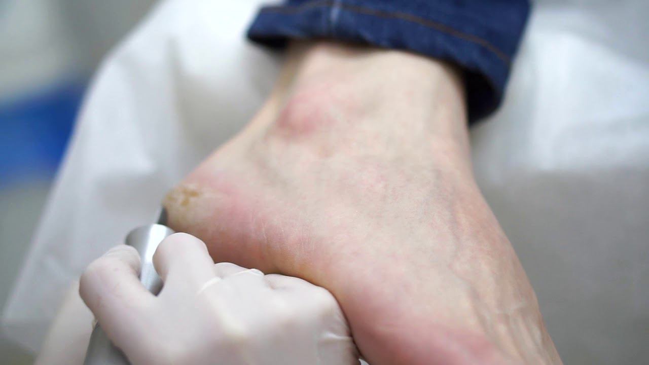 Аппаратная обработка стоп смотреть онлайн