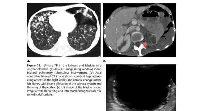 Radiological evaluation of extra pulmonary TB смотреть онлайн
