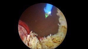 Лазерная энуклеация аденомы предстательной железы