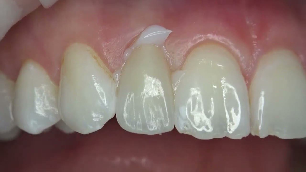 Установка керамических виниров смотреть онлайн