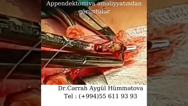 Kəskin appendisit смотреть онлайн