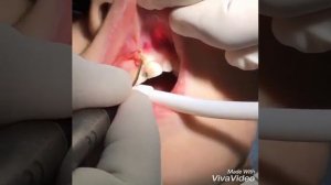 Подрезание уздечки верхней губы, с помощью лазера