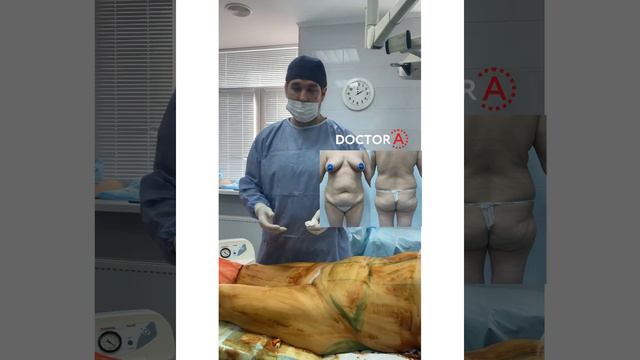 Абдоминопластика с переносом пупка. Амжад Аль-Юсеф смотреть онлайн