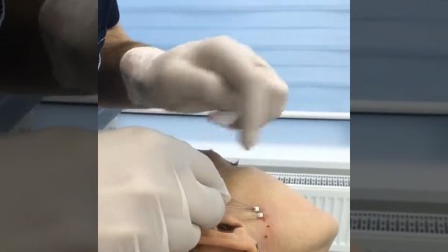 Нитевой лифтинг . Лифтинг лица. Подтяжка лица. смотреть онлайн