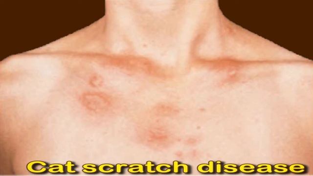 Swollen Lymph Nodes In The Groin: Causes And Symptoms смотреть онлайн