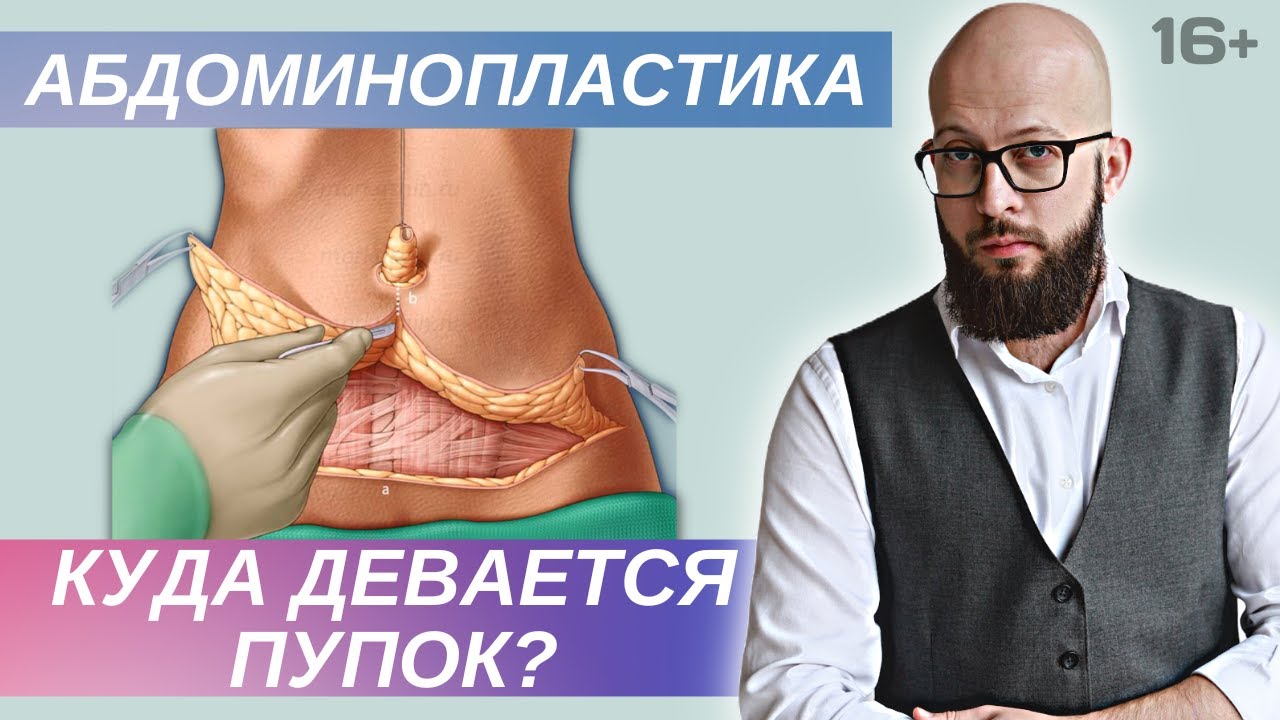 Абдоминопластика и миниабдоминопластика с переносом пупка - отличия. Диастаз при абдоминопластике. смотреть онлайн