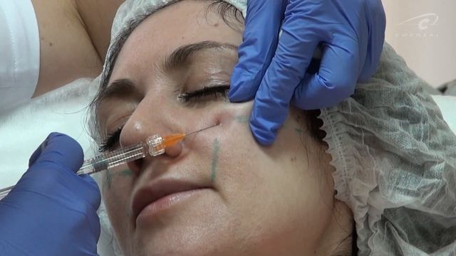 На какой глубине работает канюля в скуловой области? смотреть онлайн