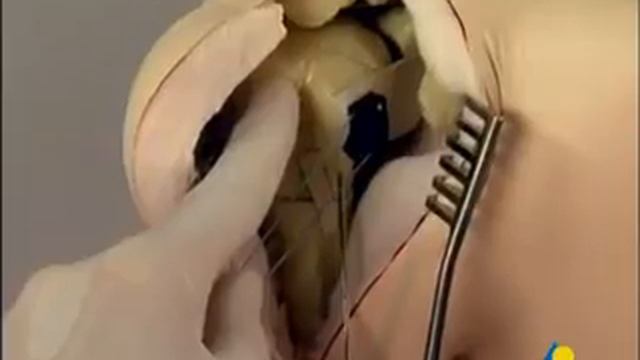 AO humerus proximal fixation with PHILOS plate смотреть онлайн
