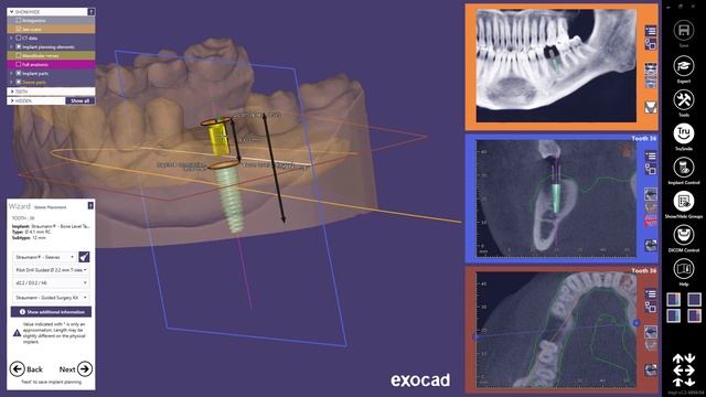 exocad Quick Guide: Get most out of guided surgery смотреть онлайн