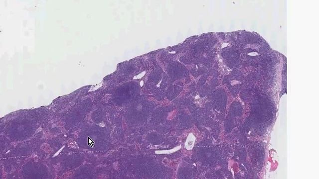 Histopathology Lymph node--Mantle cell lymphoma смотреть онлайн