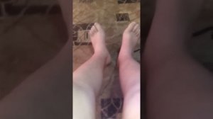 Перелом большеберцовой кости