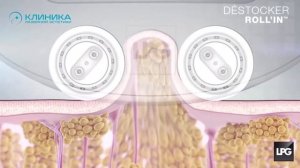 LPG массаж на оригинальном аппарате или на подделке , есть ли разница ?