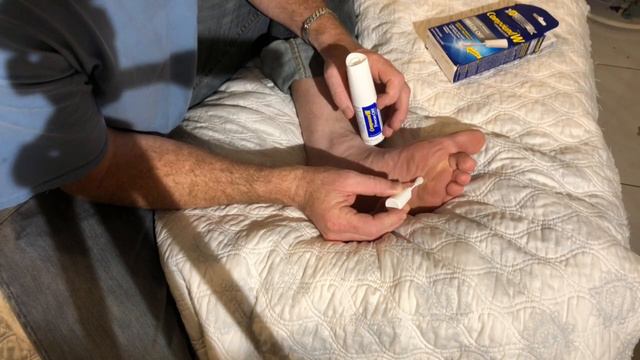 How To Remove A Plantar Wart At Home, Compound W Freeze Off Wart Removal System Used On My Foot