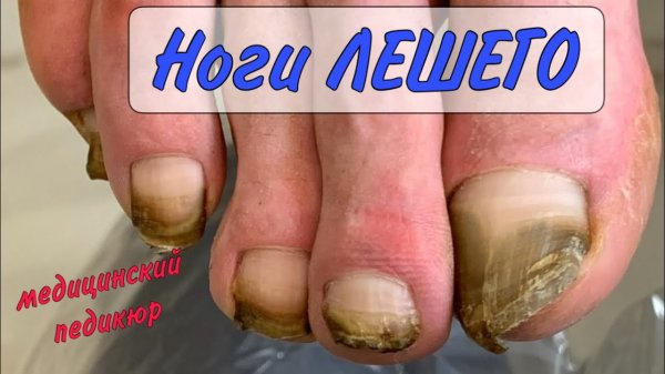 ЛЕШИЙ на педикюре/ Из РАБСТВА на педикюр / медицинский педикюр