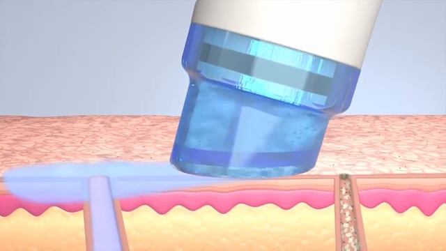 HydraFacial MD смотреть онлайн