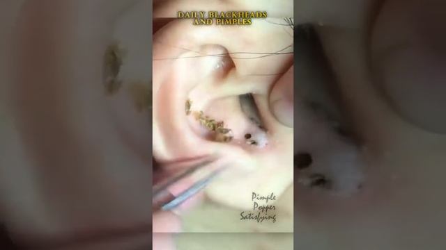 черная точка в ухе глубокая