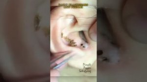 черная точка в ухе глубокая