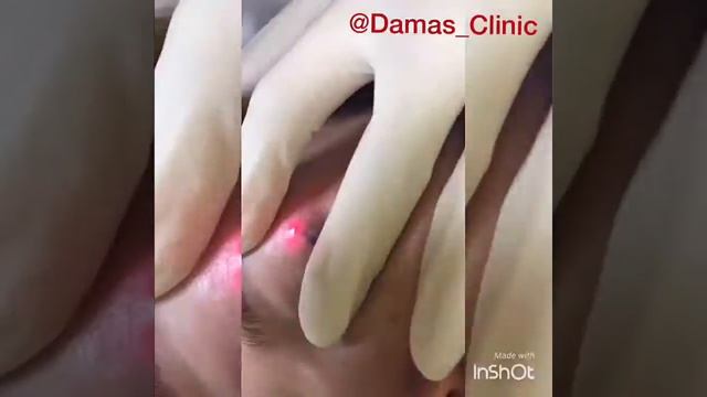 Удаление татуажа век в клинике "Damas" смотреть онлайн