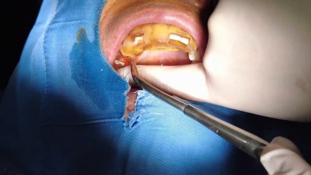 #16,17 Implants Placement, Sinus Lifting And Alveolar Crest Bone Graft - Implant Surgical Guide