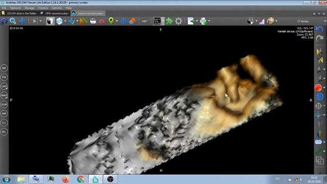 КТ АНГИОГРАФИЯ , ГОЛОВА И ШЕЯ .