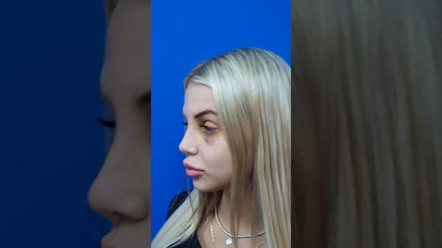 НОС КАК У МАЙКЛА ДЖЕКСОНА! Работа доктора Абрамяна смотреть онлайн