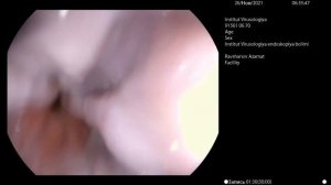 Гастроскопия. Рубцова-язвенного деформация луковицы 12-п.к.