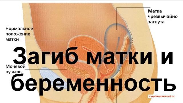 Загиб Матки и Беременность смотреть онлайн