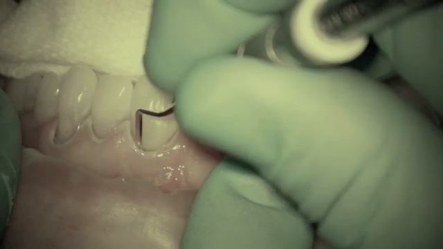 Class V Restoration Demonstration | Dental Online Training смотреть онлайн