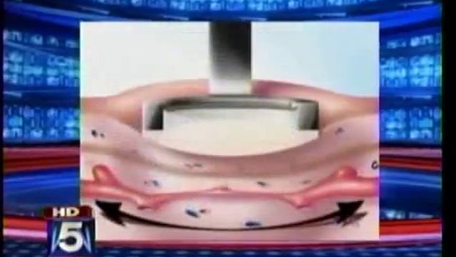 Candela Vbeam rosacea treatment on Fox news on February 2, 2010 смотреть онлайн