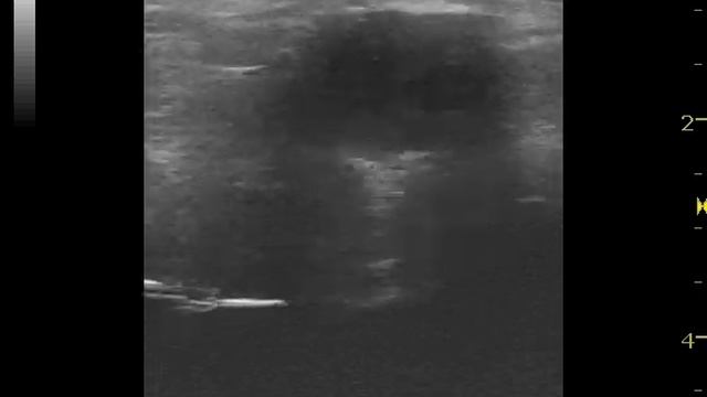 тромбированная аневризма подколенной артерии смотреть онлайн