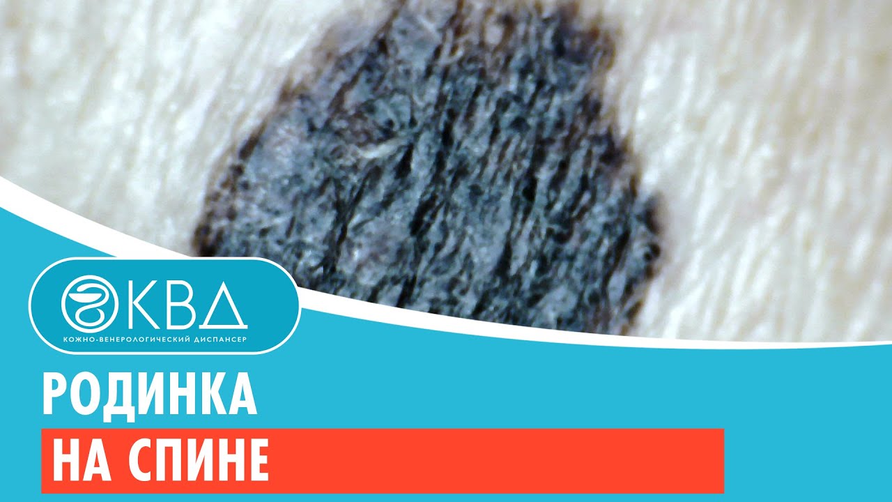 ? Родинка на спине. Клинический случай №240