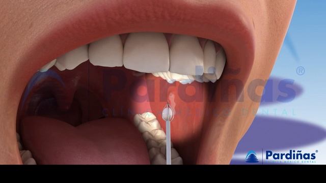 Mumps (parotitis) and other salivary glands conditions: sialadenitis, sialolithiasis, mucocele © смотреть онлайн