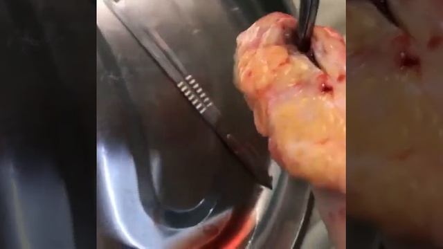 копчиковая киста смотреть онлайн