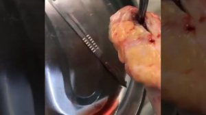 копчиковая киста