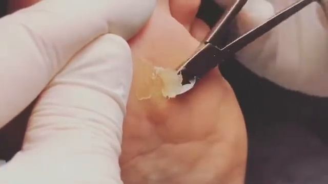 Удаление мозоли. Натоптыши. Педикюр. Подология смотреть онлайн