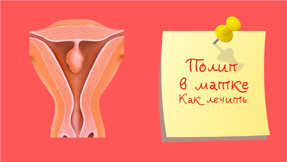 Полип в матке | Как лечить