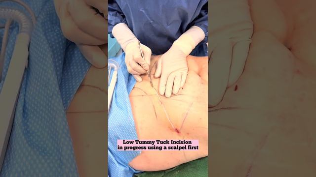 Tummy Tuck And Liposuction With Dr Rose | Six Surgery | Toronto