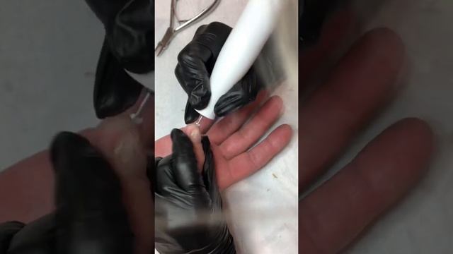 Можно ли вылечить псориаз ногтей. смотреть онлайн