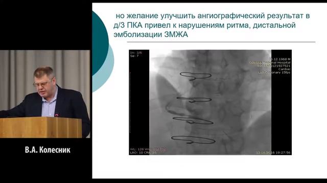 Подходы к лечению ОКС с многососудистым поражением. Колесник В.А. смотреть онлайн