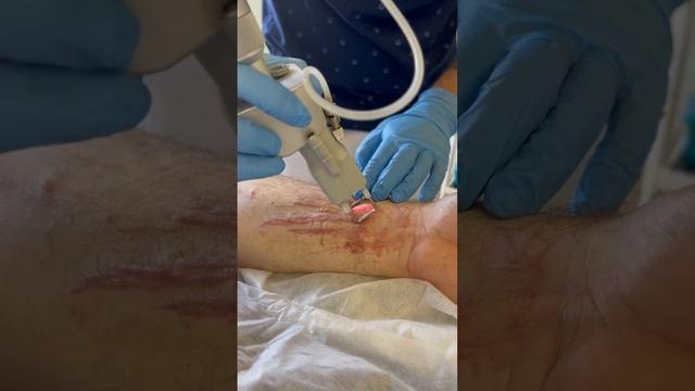 Лазерное удаление шрамов смотреть онлайн