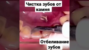 чистка зубов от камня, отбеливание зубов в домашних условиях без БОЛИ