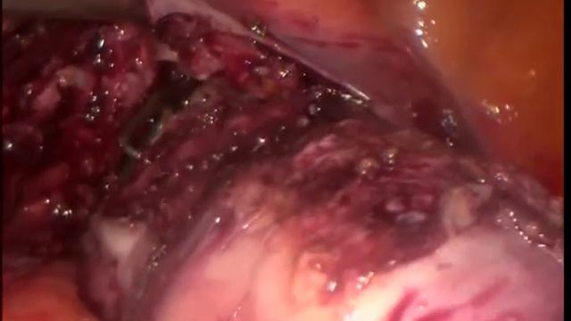 Лапароскопическая гистерэктомия с сохранением придатков смотреть онлайн