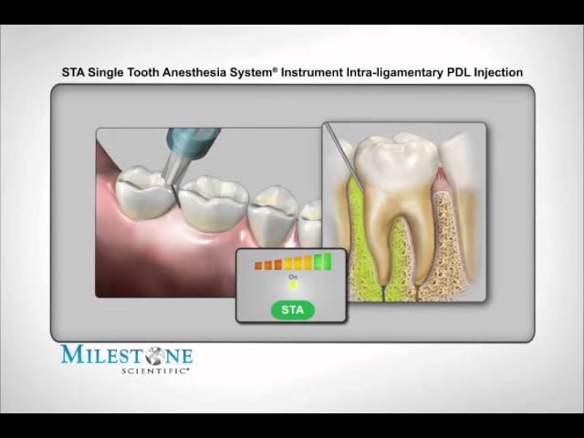 STA-модифицированая интралигаментарная анестезия