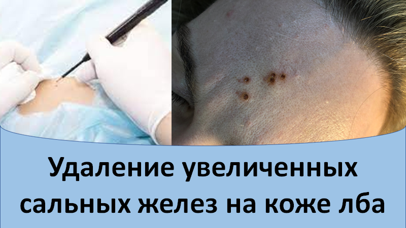 Удаление увеличенных сальных желез кожи лба смотреть онлайн
