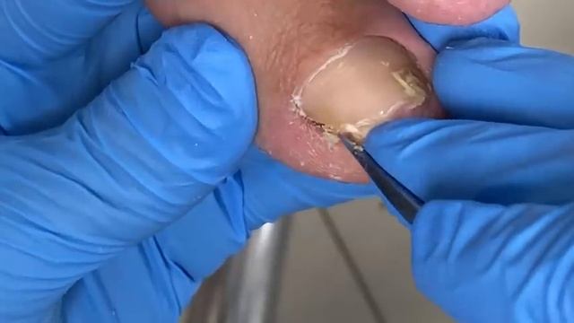 Pedicure Tutorial: Large, deep ingrown nails causing foot problems【Xue Yidao】 смотреть онлайн