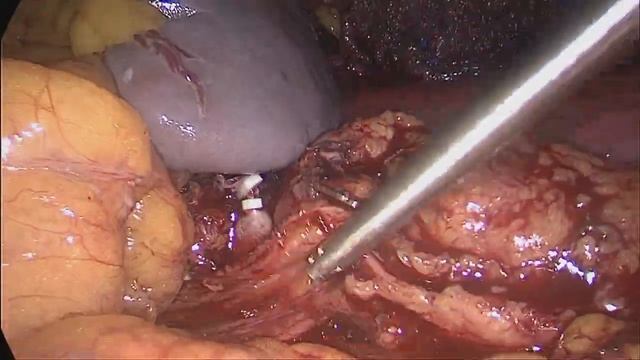 left laparoscopic radical nephrectomy with lymph node dissection. смотреть онлайн