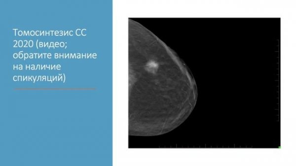 BI-RADS 6  КЛИНИЧЕСКИЙ СЛУЧАЙ ОТ "А" ДО "Я" №5