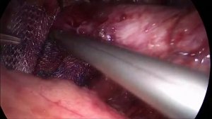 Лапароскопическая пластика грыжи пищеводного отверстия диафрагмы