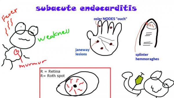 Streptococcus Viridans