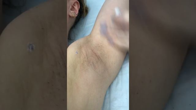 Лазерная эпиляция александритовый лазер Candela